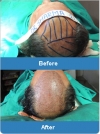 Best Hair Transplant Surgeons and Clinics in India @ Best Cost!