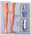 Varicose Veins - Relieving Symptoms, Improving Appearance, Preventing Complications.