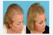 Get the best Microneedling for Alopecia Treatment